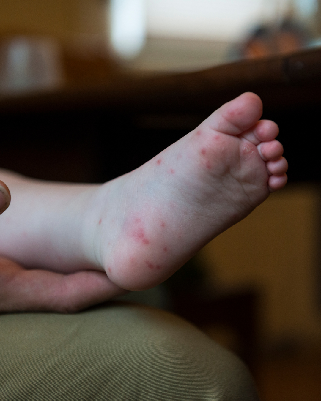 hand foot and mouth disease blisters on a child's foot