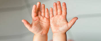 hand, foot and mouth blisters on child's palms